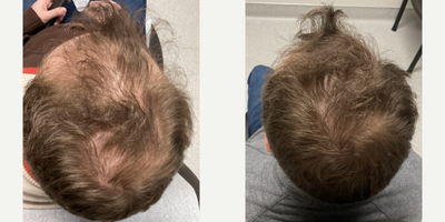 Hair Loss Treatment before and after photo