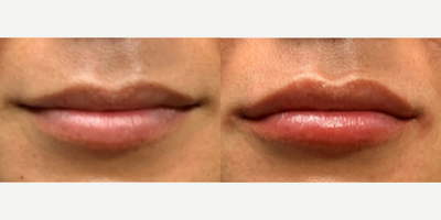 Juvederm before and after photo
