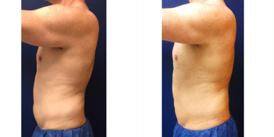 Liposuction Revision before and after photo