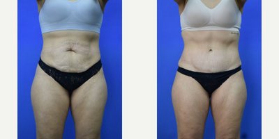 Liposuction before and after photo