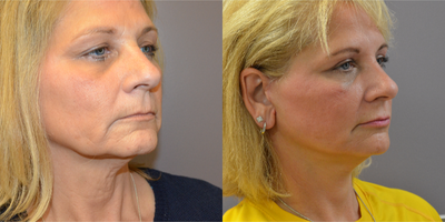 Mini Facelift before and after photo