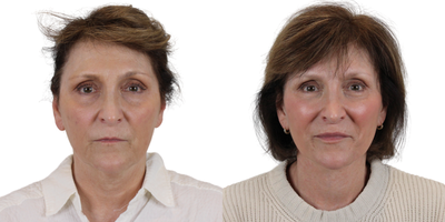 Neck Lift before and after photo