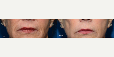 ThermiSmooth Face before and after photo