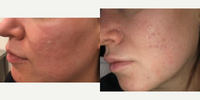 Bellafill before and after photo