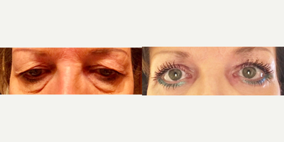 Eyelid Surgery before and after photo