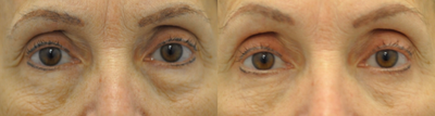 Eyelid Surgery before and after photo