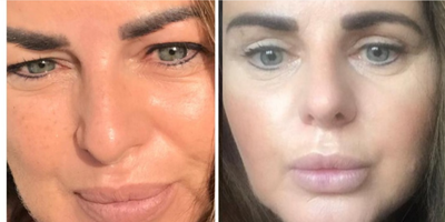 Eyelid Surgery before and after photo