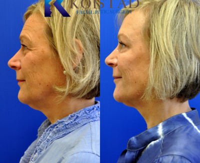 Brow Lift before and after photo