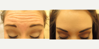 Dysport before and after photo