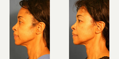 Facelift before and after photo