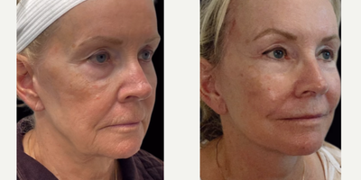 Facelift before and after photo