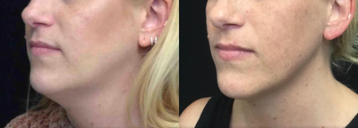 CoolSculpting before and after photo