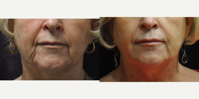 Dermal Fillers before and after photo