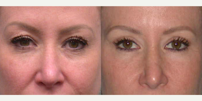 Eyelid Surgery before and after photo