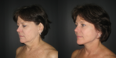 Facelift before and after photo