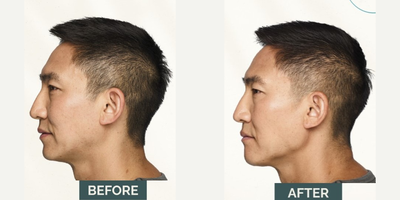 Juvederm before and after photo