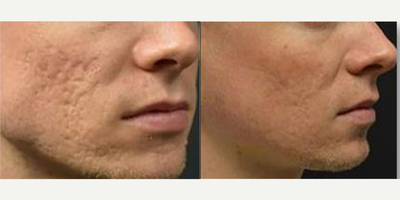 Microneedling RF before and after photo