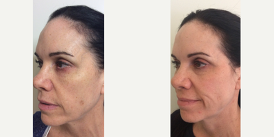 Coolaser before and after photo