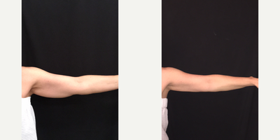 CoolSculpting before and after photo