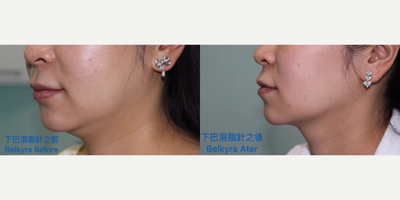 Kybella before and after photo