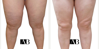 Liposuction before and after photo