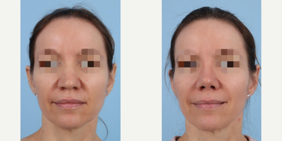 Rhinoplasty before and after photo