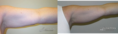 Tumescent Liposuction before and after photo