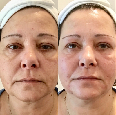 Voluma before and after photo
