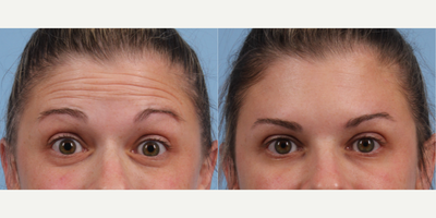 Botox before and after photo