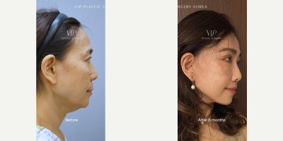 Botox before and after photo