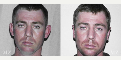 Ear Surgery before and after photo