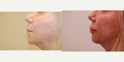 Lip Fillers before and after photo