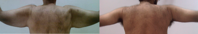 Arm Lift before and after photo