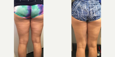 BodyFX before and after photo