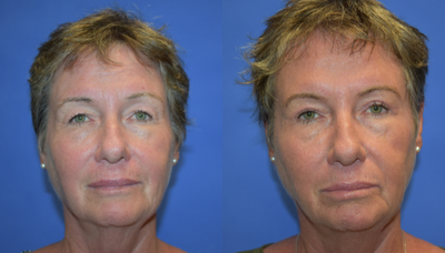 Eyelid Surgery before and after photo