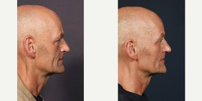 Eyelid Surgery before and after photo