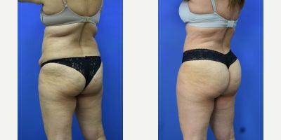 Liposuction before and after photo