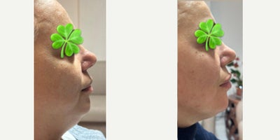 Mesotherapy before and after photo