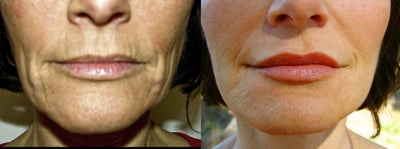 Nonsurgical Facelift before and after photo