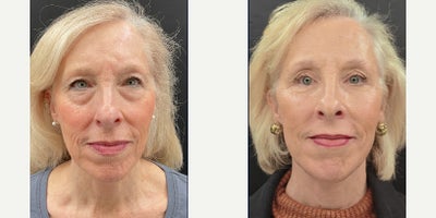 Deep Plane Facelift before and after photo