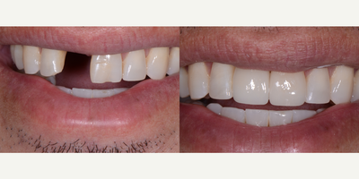 Dental Implants before and after photo