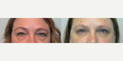 Eyelid Surgery before and after photo