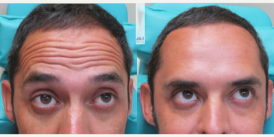 Botox before and after photo