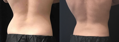CoolSculpting before and after photo