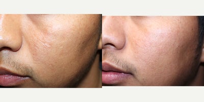 Dermal Fillers before and after photo