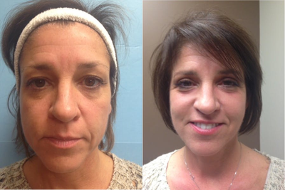 Facelift before and after photo