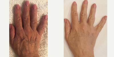 Hand Rejuvenation before and after photo