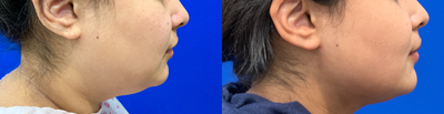 Liposuction before and after photo