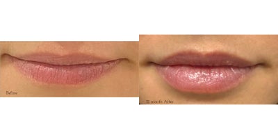 Skin Tightening before and after photo