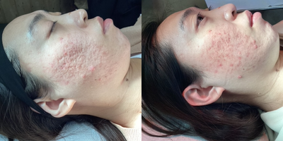 Subcision before and after photo